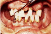 periodontal